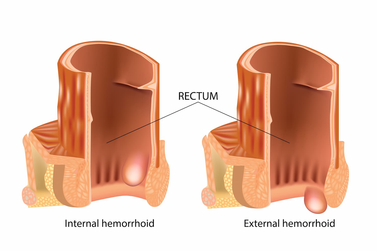 hemorrhoid skin tag