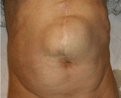 Clinical-presentation-of-a-patient-with-a-large-incisional-hernia-Conventional-hernia
