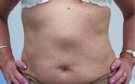 epig-hernia epig-hernia