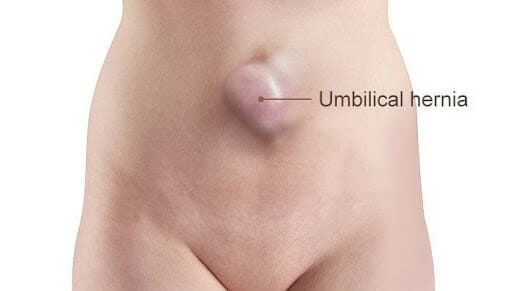 umbilical-hernia